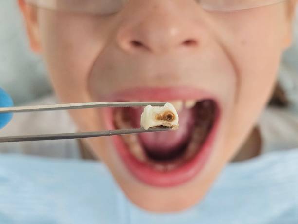 Best Pediatric Emergency Dentist in San Bruno, CA